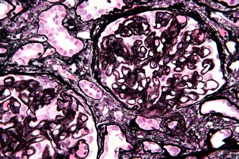 membranous proliferative glomerulonephritis.